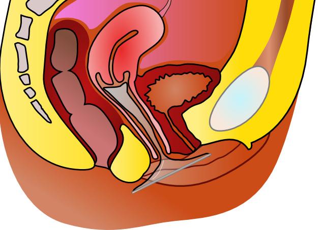 Contraception_pr%C3%A9servatif_f%C3%A9mi