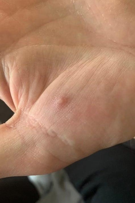 What's It Like To Get Monkeypox? We Talked To People Who Have It