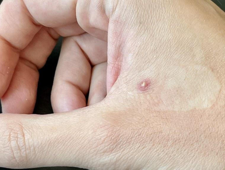 Monkeypox Pictures: How to Identify Symptoms of Monkeypox