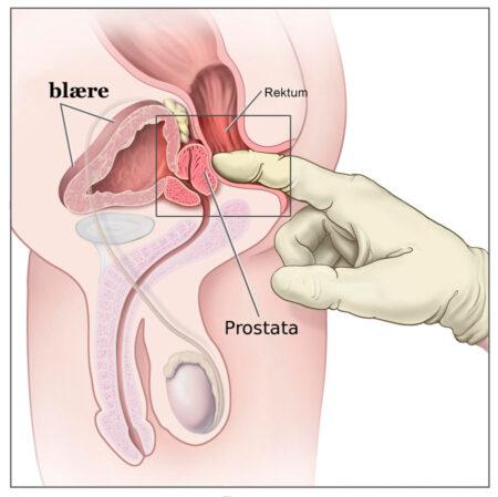 prostata-massage-3-450x449.jpg